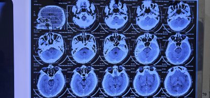 Phát hiện sán chi chít trong người sau khi ăn món nhiều người mê