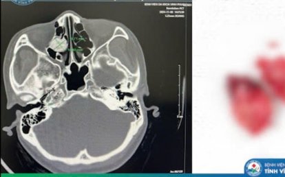 Người phụ nữ 35 tuổi ở Vĩnh Phúc bất ngờ phát hiện u màng não kích lớn từ dấu hiệu nhiều người Việt bỏ qua